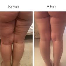 Khloe Kardashians Butt Secret To Reduce Cellulite Fascia