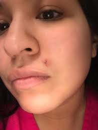 old lip piercing scar removal austin