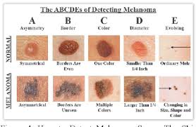 Every hour, one person in america dies from melanoma, the. Figure 4 From Skin Cancer Concerns In People Of Color Risk Factors And Prevention Semantic Scholar