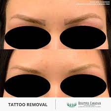 vancouver microblading removal