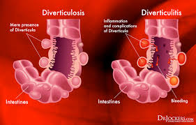 diverticulitis causes symptoms