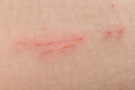 stockfoto scratch marks on skin surface