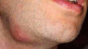 skin abscess causes diagnosis and