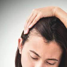 hair loss and testosterone