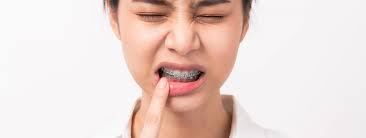 braces cause painful mouth ulcers