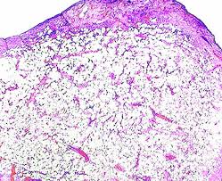 pathology outlines lipoma
