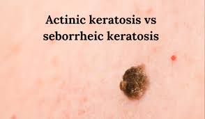 actinic keratosis vs seborrheic
