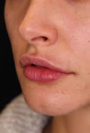 lips to be uneven after lip filler