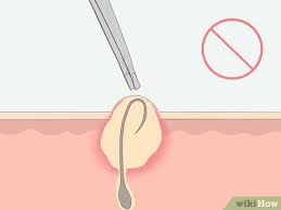 how to get rid of an ingrown hair