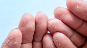 fingertips ling 12 causes and