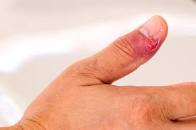 fingernail infection