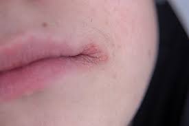 5 s to help you manage lip eczema