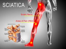 The focused manual pressure and stretching used in myofascial release therapy loosen up restricted movement, leading indirectly to reduced pain. Best Ways To Treat Sciatica Pain Colorado Pain Care