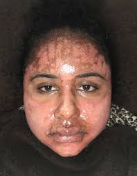 acne scar vitalizer treatment photo