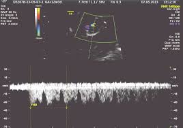 Normal Fetal Heart Rate Of 140 Bpm And Normal Ductus Venosus