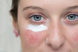 what are the best s for rosacea