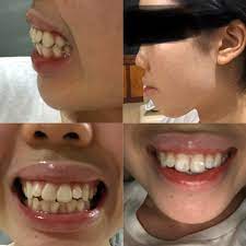 If you have a severe overbite, the lower teeth may be covered altogether, and may even reach the upper gum line when biting down. Jaw Surgery Necessary Gummy Smile And Ugly Teeth Jawsurgery