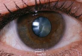 cataracts eye disease sles bay