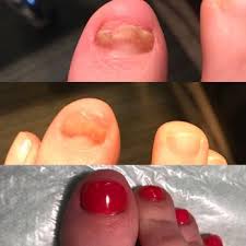 northwest hand foot and nail therapy