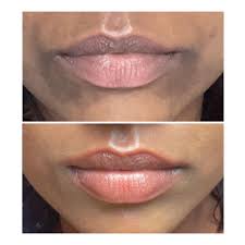 lip lightening treatment cost in
