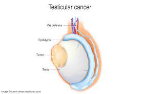 Read about testicular cancer (cancer of the testicle), including information about symptoms, causes, diagnosis and treatment. Signs Of Testicular Cancer