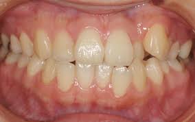 「八重歯」の画像検索結果