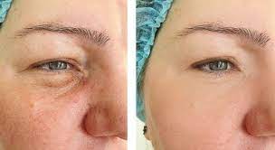 ipl rosacea and acne treatment
