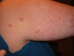 The spots are caused by bleeding underneath the skin secondary to platelet disorders, vascular disorders, coagulation disorders, or other causes. Henoch Schonlein Purpura Johns Hopkins Vasculitis Center
