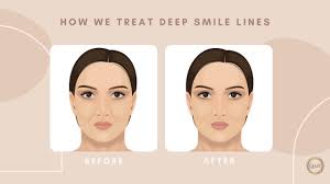 what you can do about smile lines