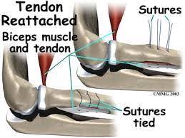 what is a biceps tendon rupture and how