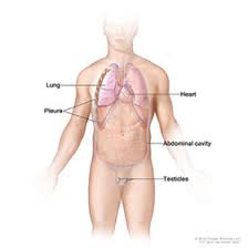 mesothelioma (frequently called malignant mesothelioma) is a cancer that starts in cells that line certain parts of the body, especially the chest or abdomen. What Is Mesothelioma Osuccc James