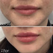 thinning or uneven lips the cosmetic