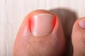 ingrown toenail treatment in singapore
