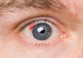 blood clot in the eye and how to get