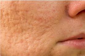 acne scarring renovo skin clinic