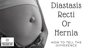 diastasis recti or hernia how to tell