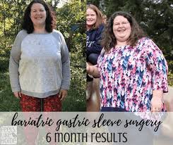 bariatric gastric sleeve surgery