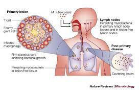 It most commonly affects the lungs. Tuberculosis A Problem With Persistence Nature Reviews Microbiology