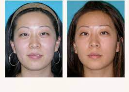 asian eye plastic surgery before and after Cheaper Than Retail Price> Buy  Clothing, Accessories and lifestyle products for women & men -
