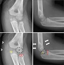 Lateral epicondylitis is defined as a pathologic condition of the wrist extensor muscles at their origin on the lateral humeral epicondyle. Medial Epicondyle Avulsion Fracture With Joint Entrapment In Children