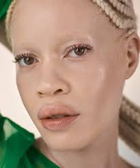 model diandra forrest albinism power faces