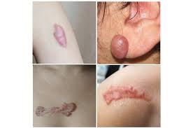 keloid acne scars what are they and