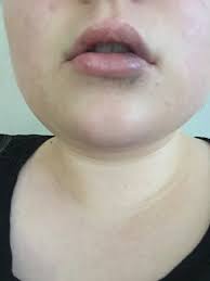 have my lip fillers gone wrong photos