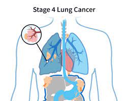 se 4 asbestos lung cancer