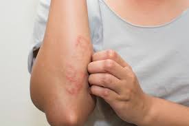 scabies on mattress and pillows