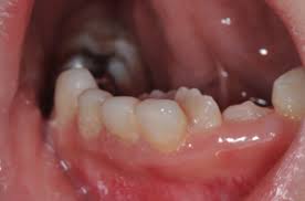 Maybe you would like to learn more about one of these? What To Do About Loose Baby Teeth