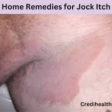 home remes for jock itch relief
