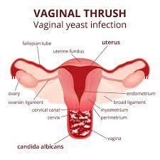 how to cure a yeast infection naturally