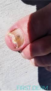 common nail discoloration