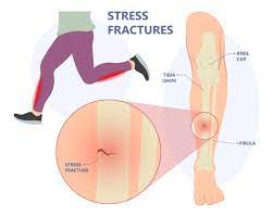 stress fracture shin symptoms and